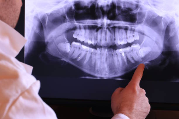 Best Emergency Treatment for Dental Infections or Abscesses in Downey, CA